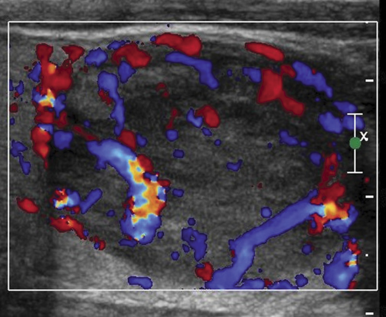 Metastatic lung carcinoma in a 63-year-old man with known lung carcinoma